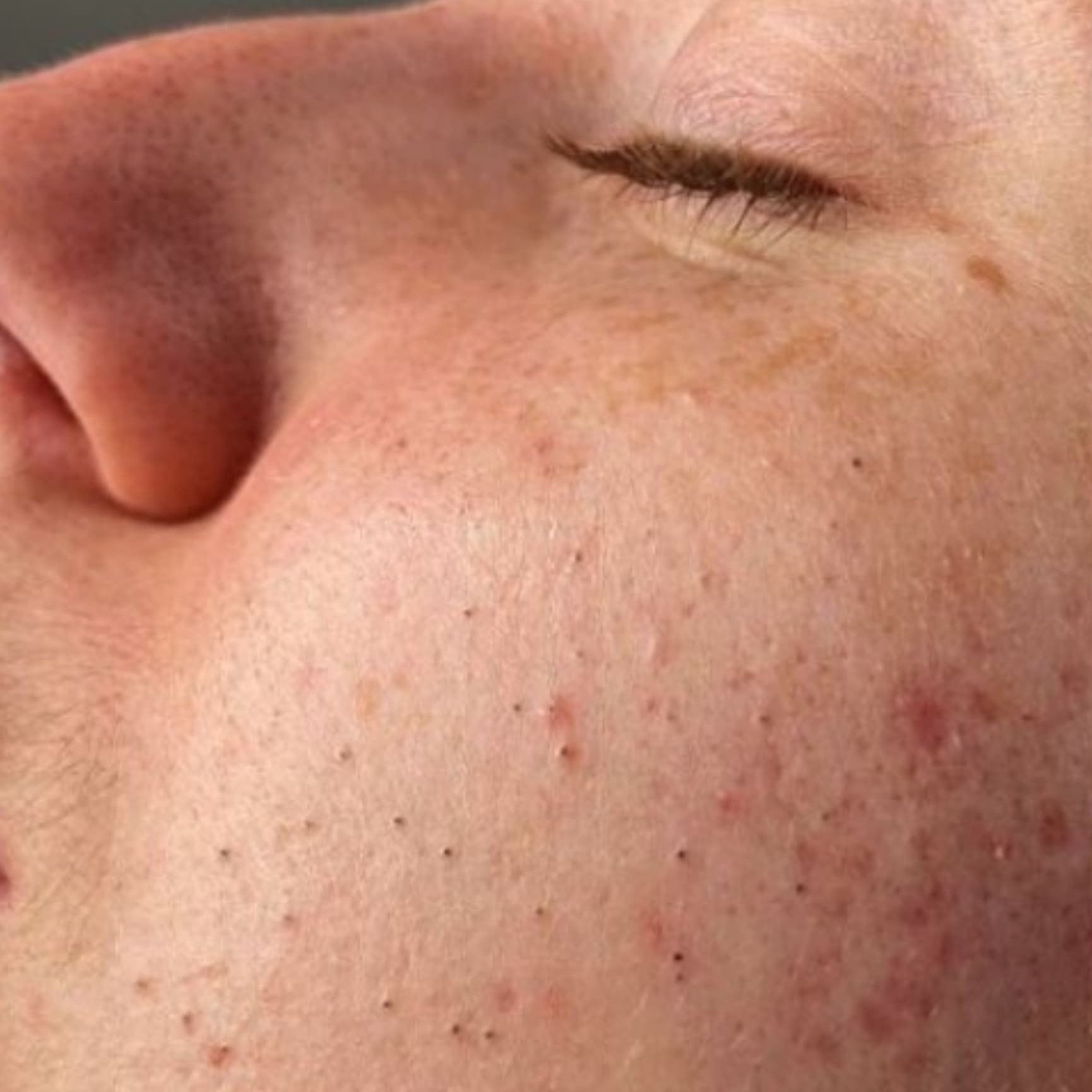 HydraFacial Before 1