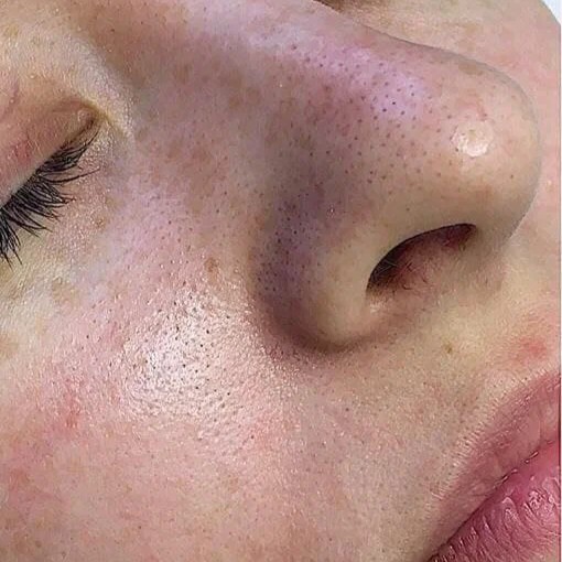 HydraFacial Before 2