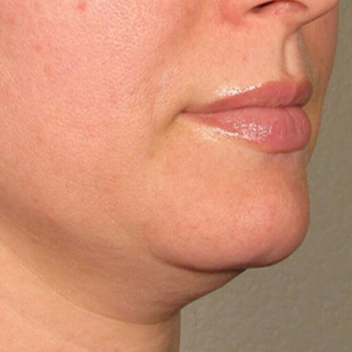 Kybella Before 1