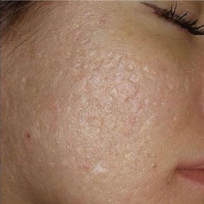 Laser Acne Scar After 1