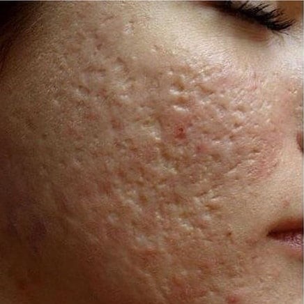 Laser Acne Scar Before 1
