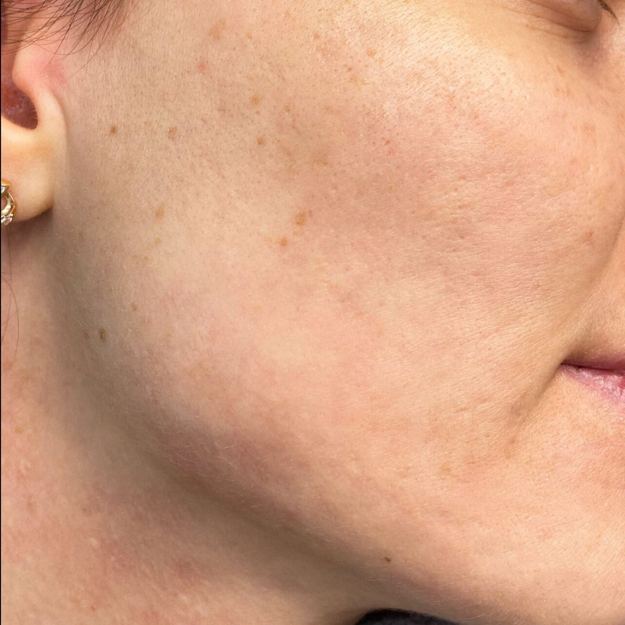 Laser Acne Treatment After 1