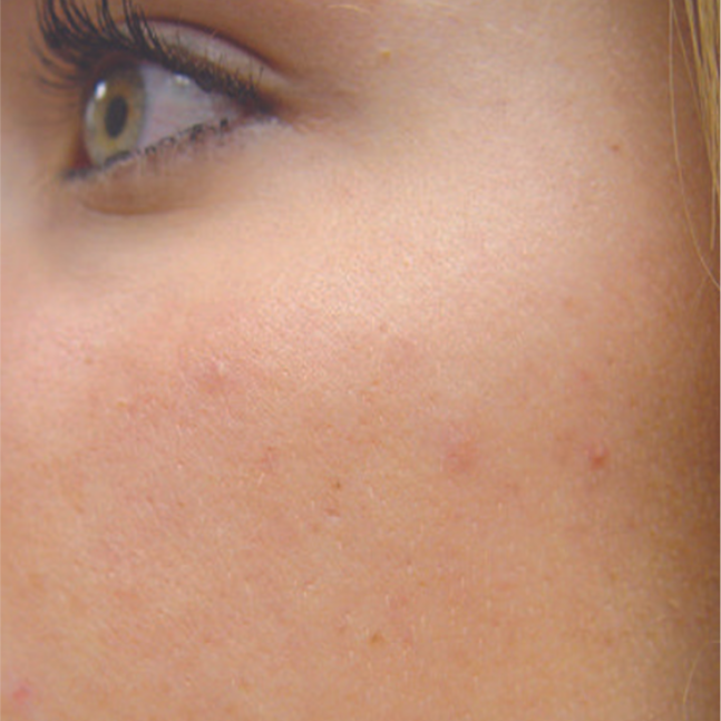 Laser Acne Treatment After 3