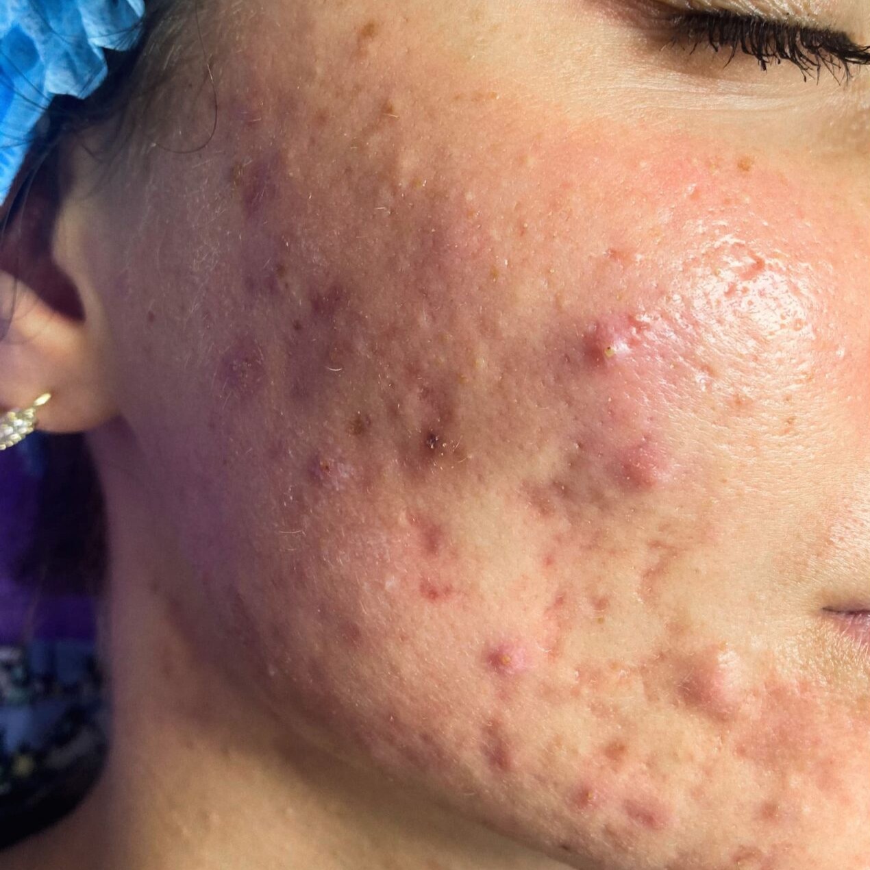 Laser Acne Treatment Before 1