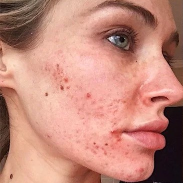 Laser Acne Treatment Before 2