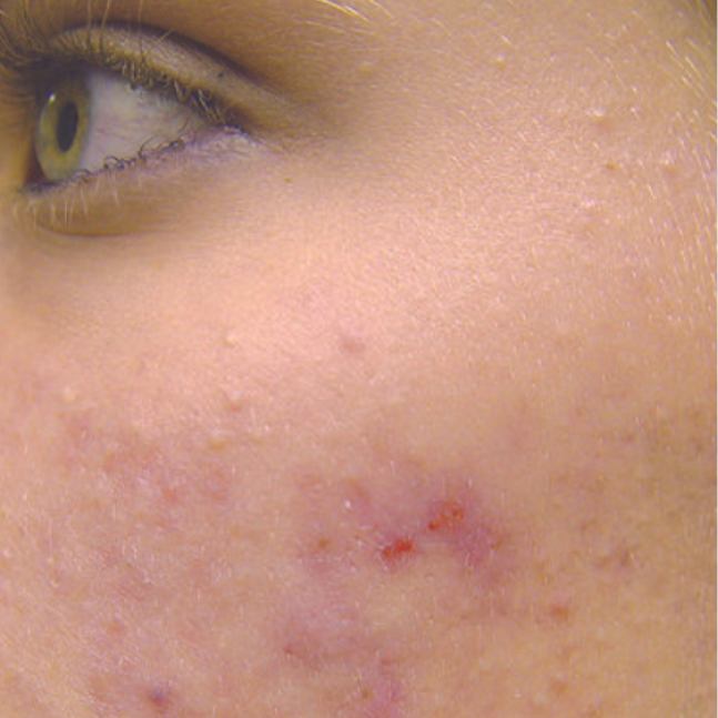 Laser Acne Treatment Before 3