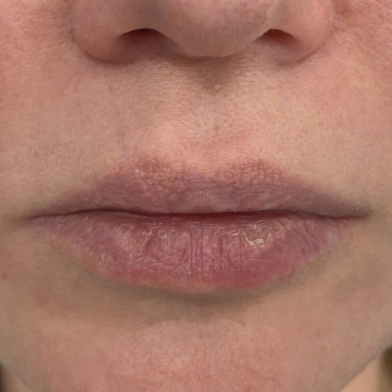 Laser Scar Revision After 1