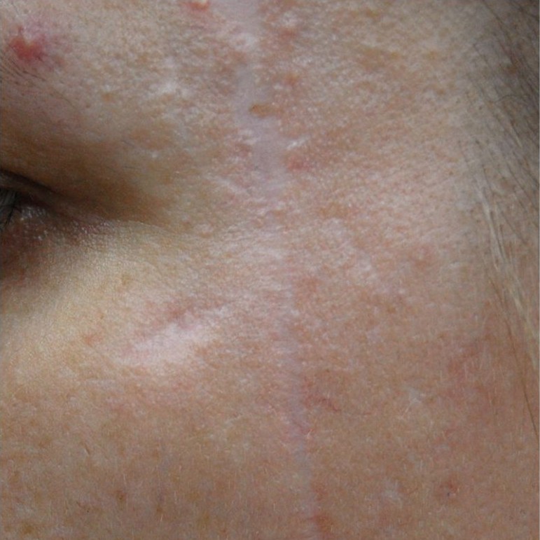 Laser Scar Revision After 2