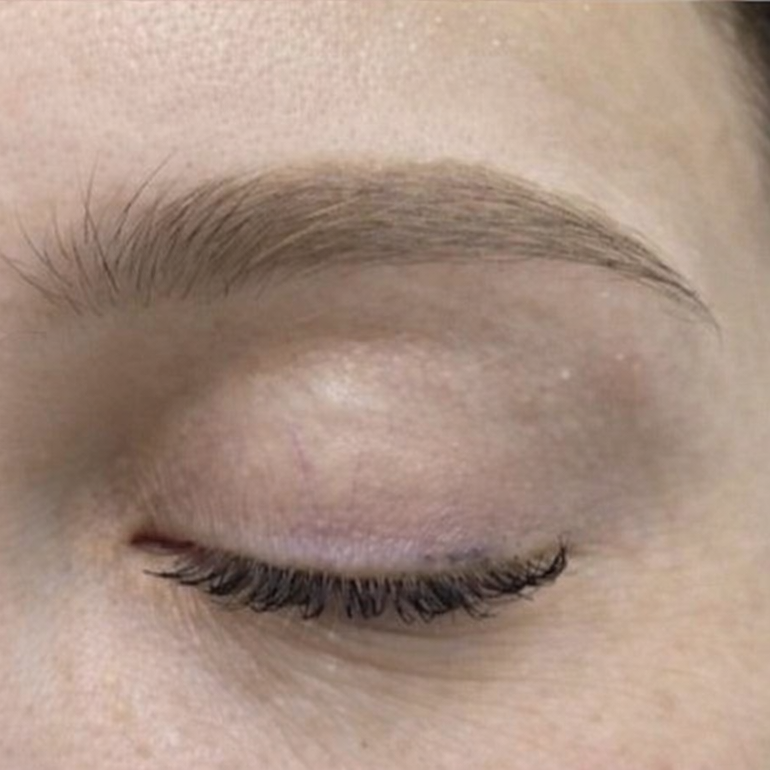 Laser Scar Revision After 3