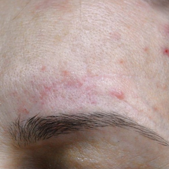 Laser Scar Revision After 4