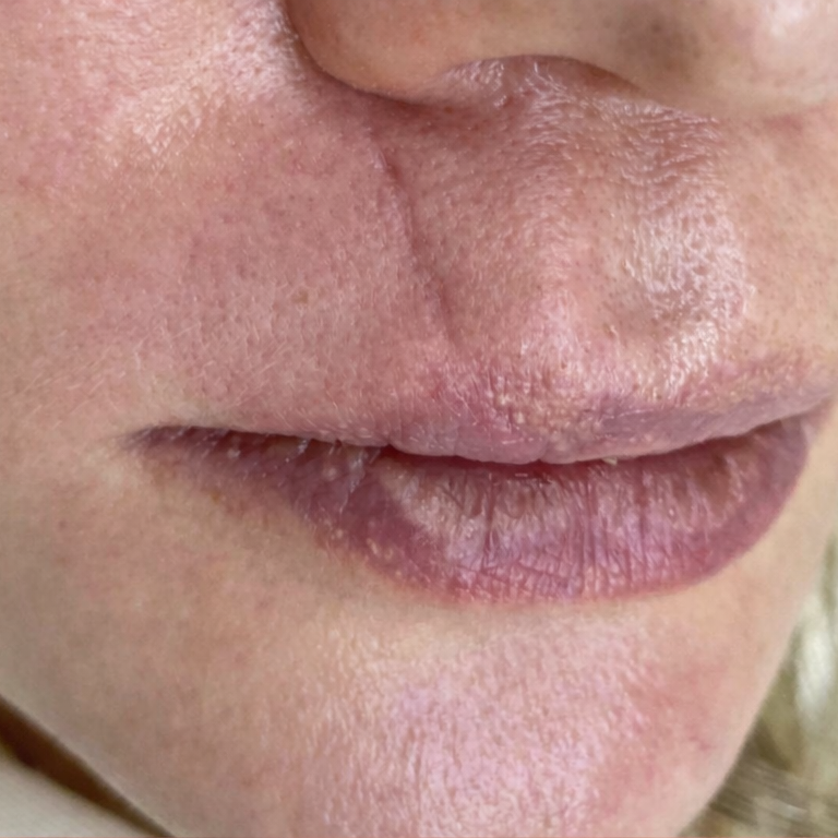 Laser Scar Revision Before 1