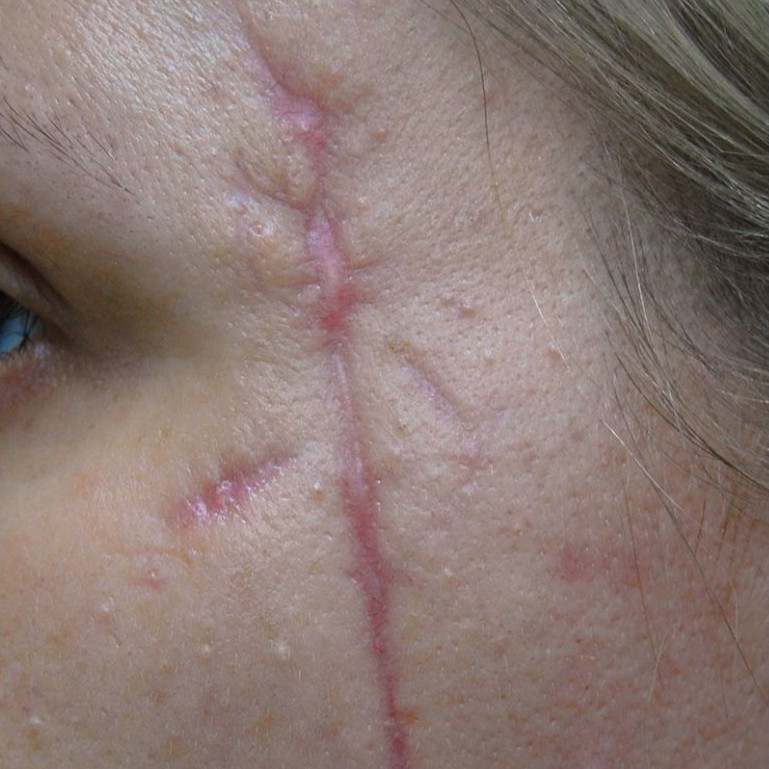 Laser Scar Revision Before 2