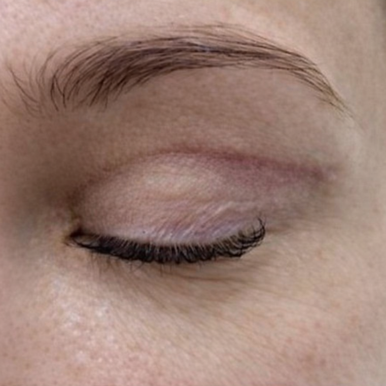 Laser Scar Revision Before 3