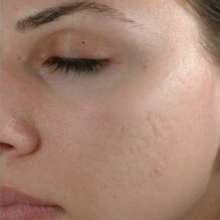 Laser Skin Resurfacing After 1