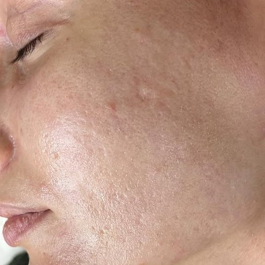 Laser Skin Resurfacing After 3