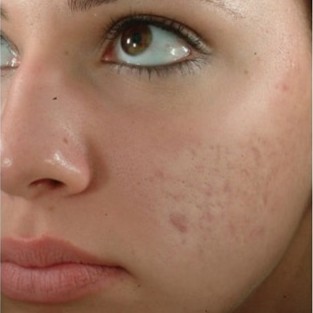 Laser Skin Resurfacing Before 1