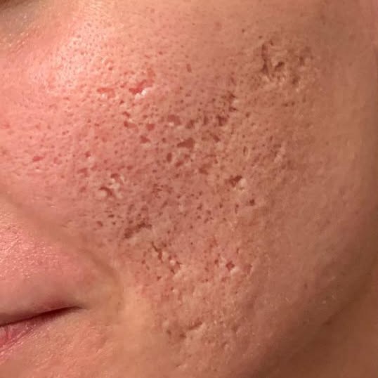 Laser Skin Resurfacing Before 3