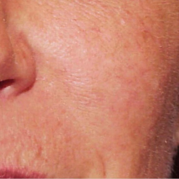 Laser Vascular Lesions Treatment After 1