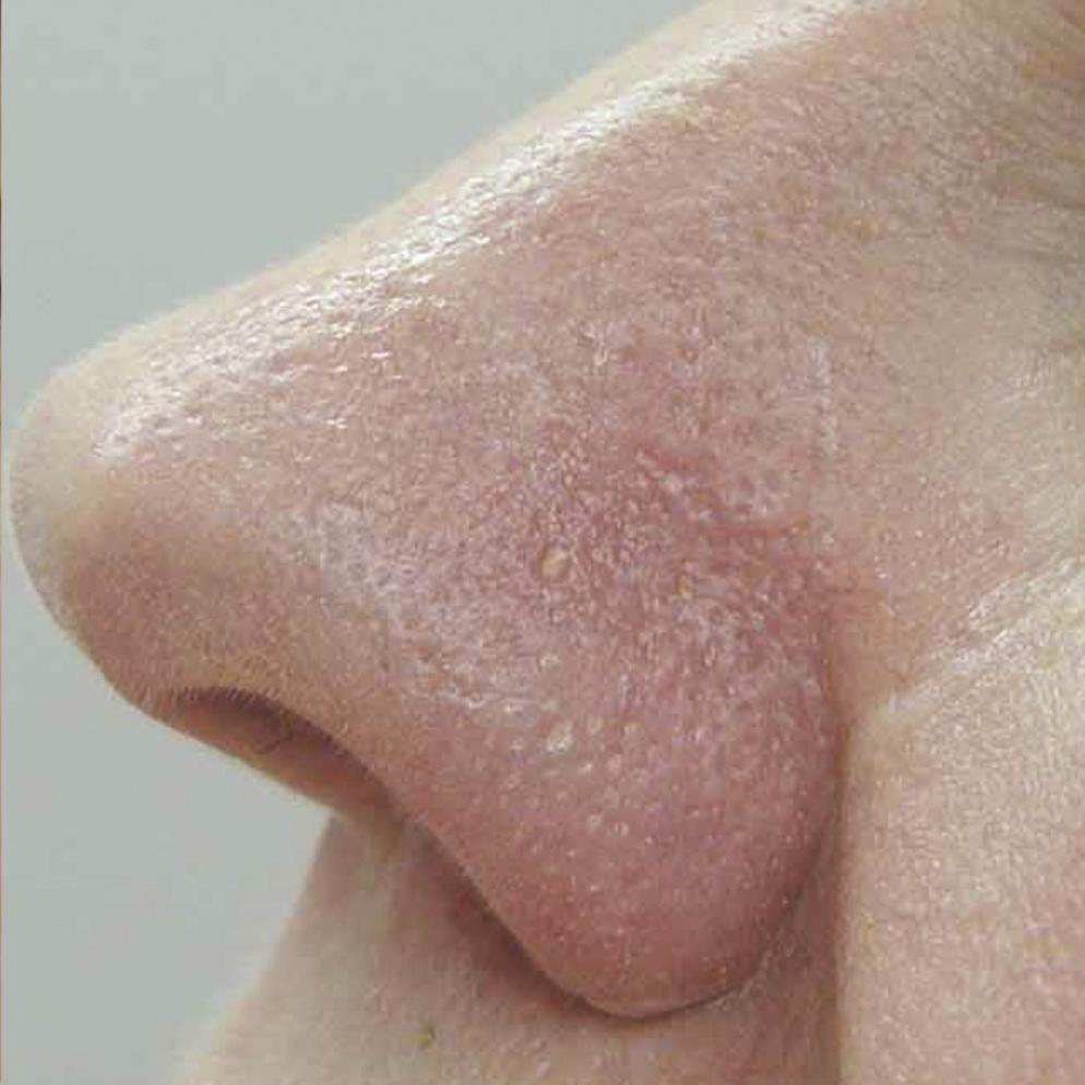 Laser Vascular Lesions Treatment After 2