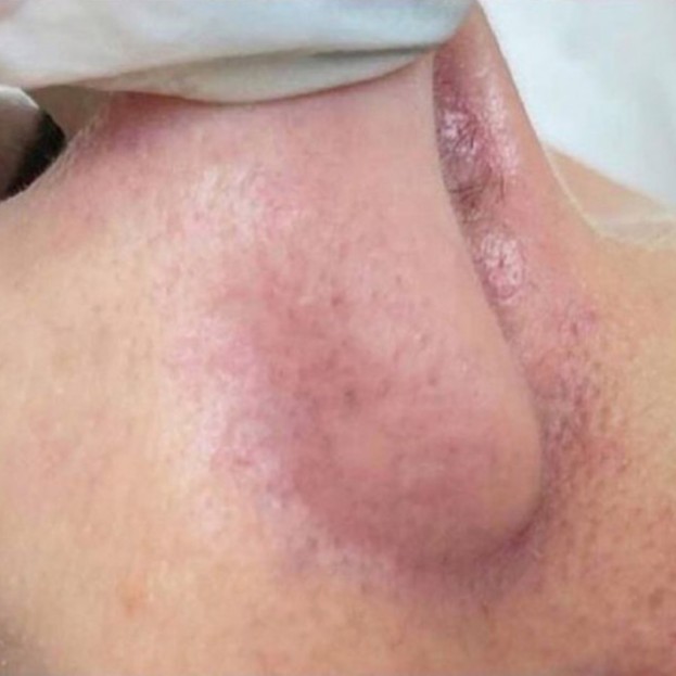 Laser Vascular Lesions Treatment After 3