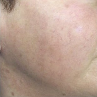 Laser Vascular Lesions Treatment After 4