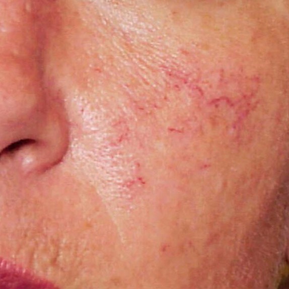 Laser Vascular Lesions Treatment Before 1