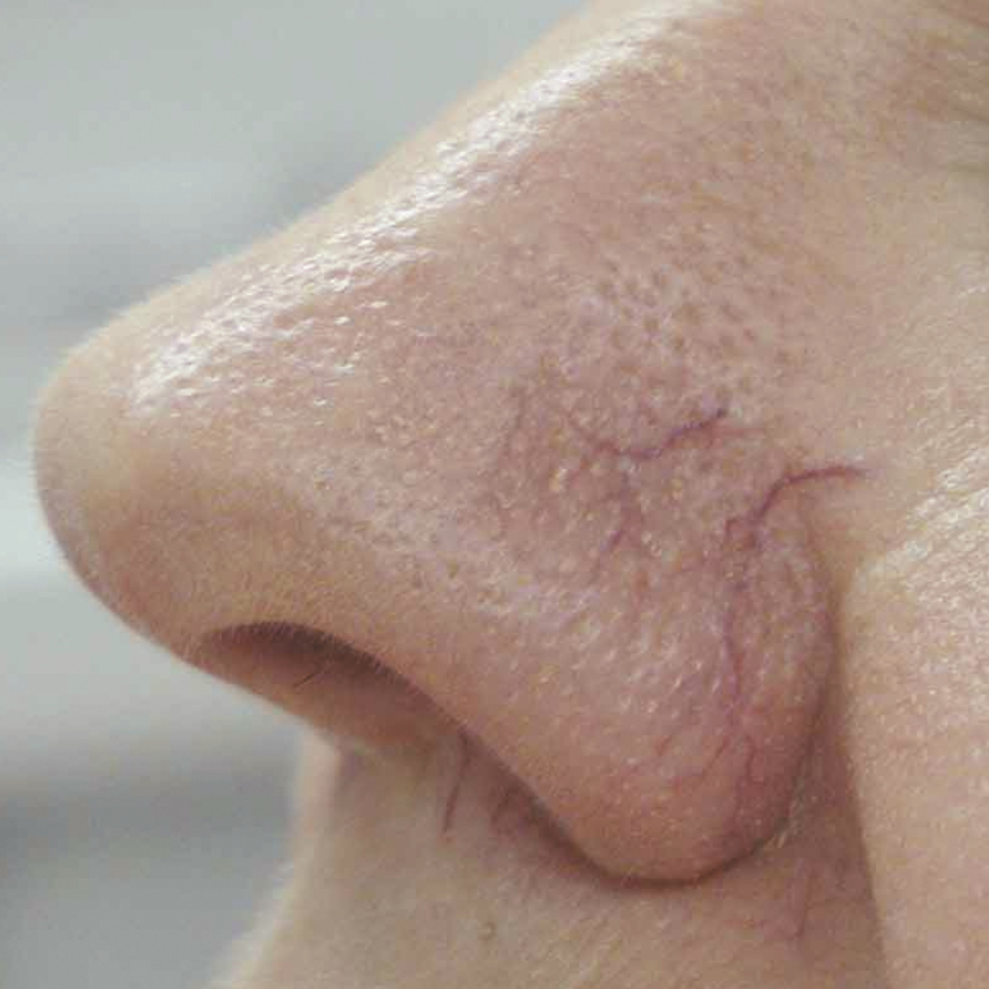 Laser Vascular Lesions Treatment Before 2