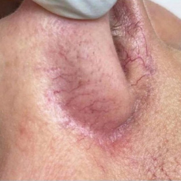 Laser Vascular Lesions Treatment Before 3