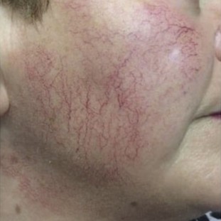 Laser Vascular Lesions Treatment Before 4