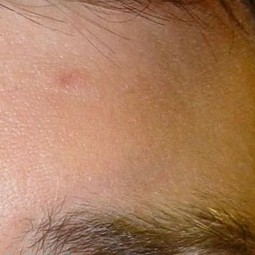 Laser Wart Removal After 1