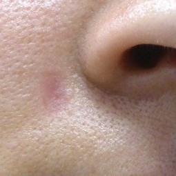 Laser Wart Removal After 2