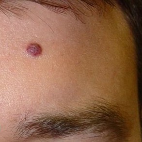 Laser Wart Removal Before 1