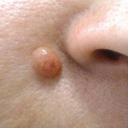 Laser Wart Removal Before 2