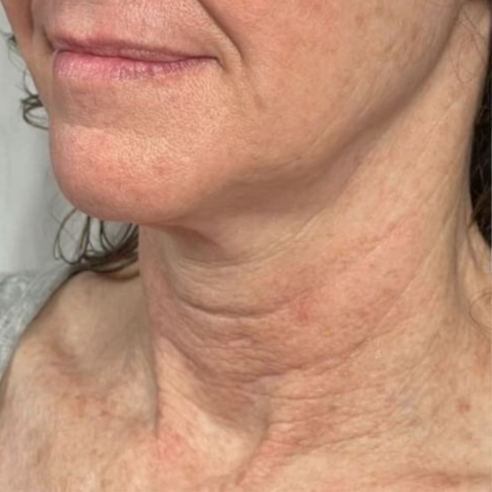 NeckLift Before 1