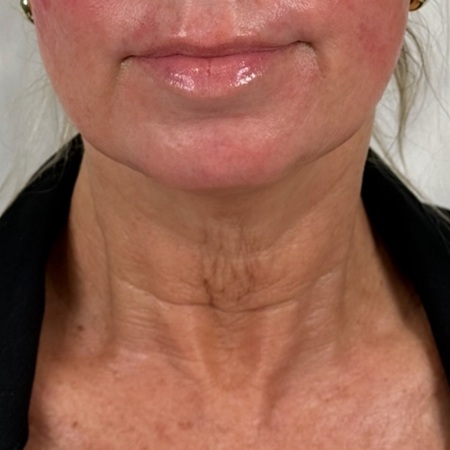 NeckLift Before 2