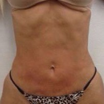 TightSculpting After 1