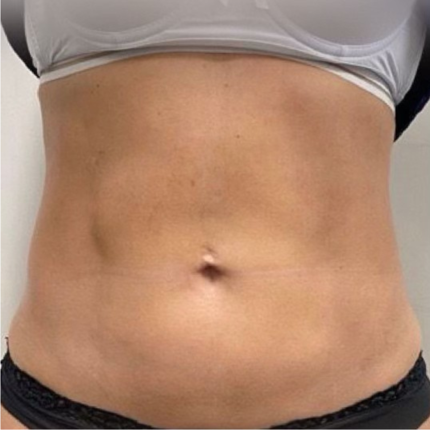 TightSculpting After 2