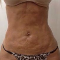 TightSculpting Before 1