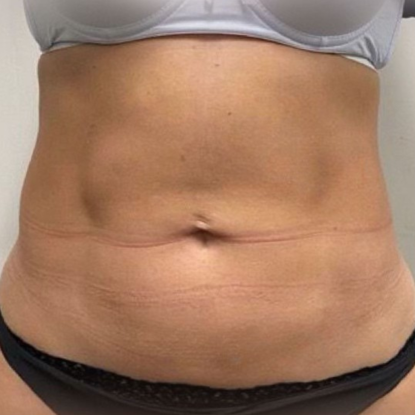 TightSculpting before 2